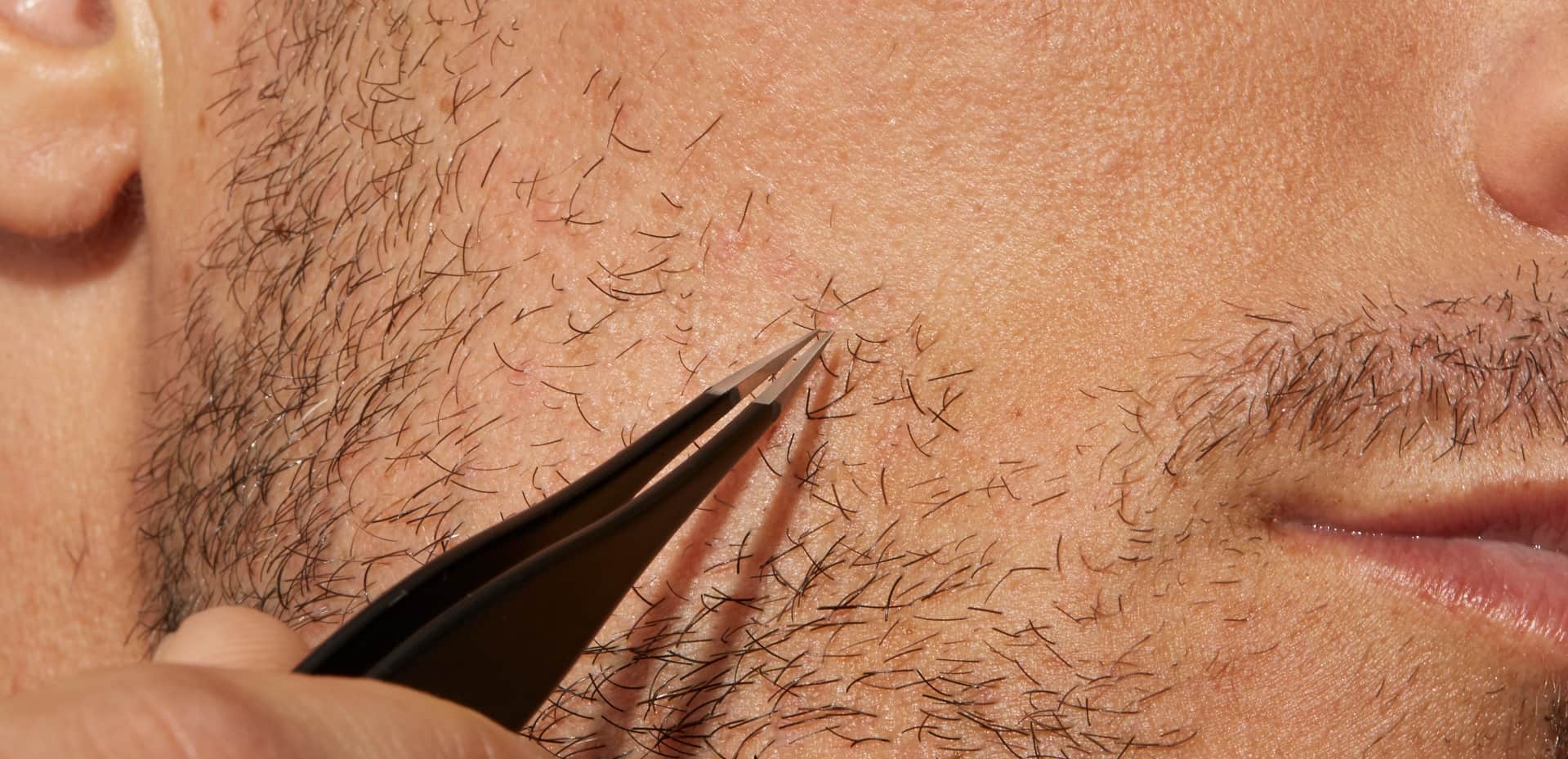 How To Get Rid Of Ingrown Hairs For Men